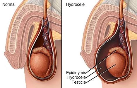 Cross-section diagram comparing normal testicular anatomy with a testicle affected by hydrocele, showing fluid collected within the tunica vaginalis
