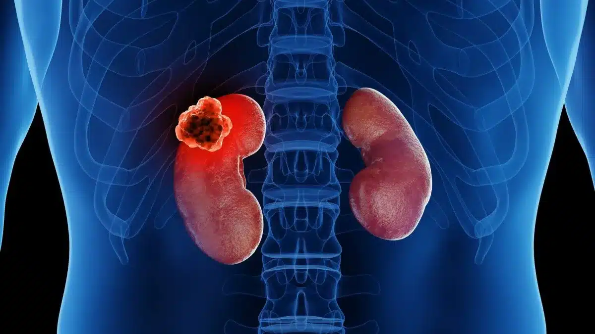 Renal kidney tumour diagnosis treatment nephrectomy Nairobi