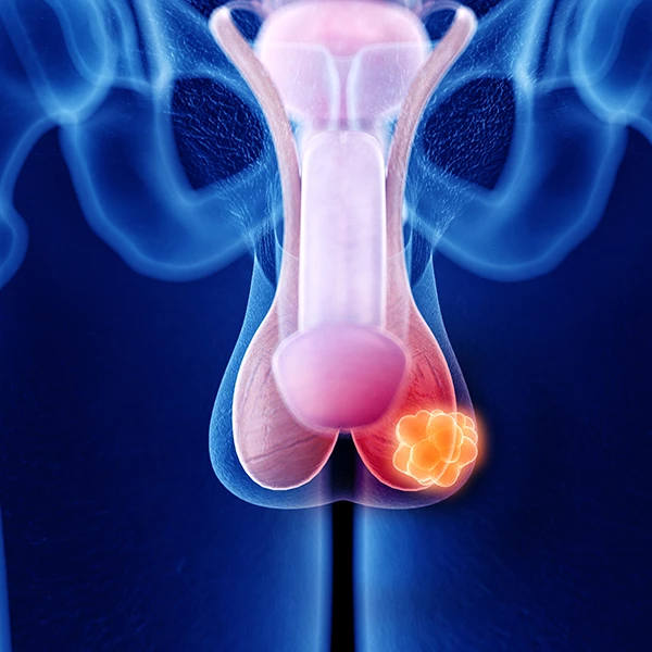 Testicular tumour assessment scrotal ultrasound specialist Nairobi